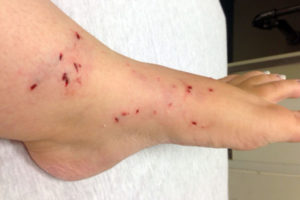 Ankle and foot of woman bit by raccoon (photo courtesy Sandra Alboum)
