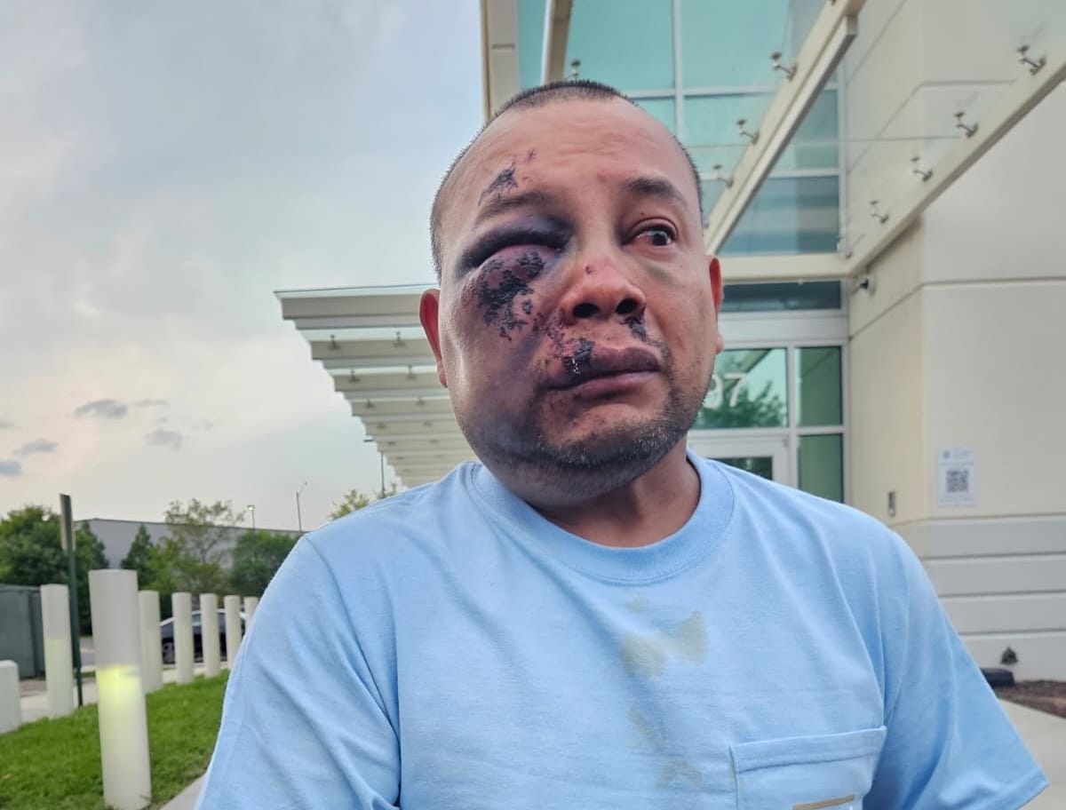 Man with a bruised face and swollen left eye wearing a light blue shirt, standing outside a modern building with glass frontage.
