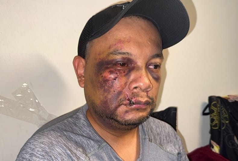 Man with severe facial bruising and a swollen, bruised eye, wearing a gray shirt and black cap indoors.