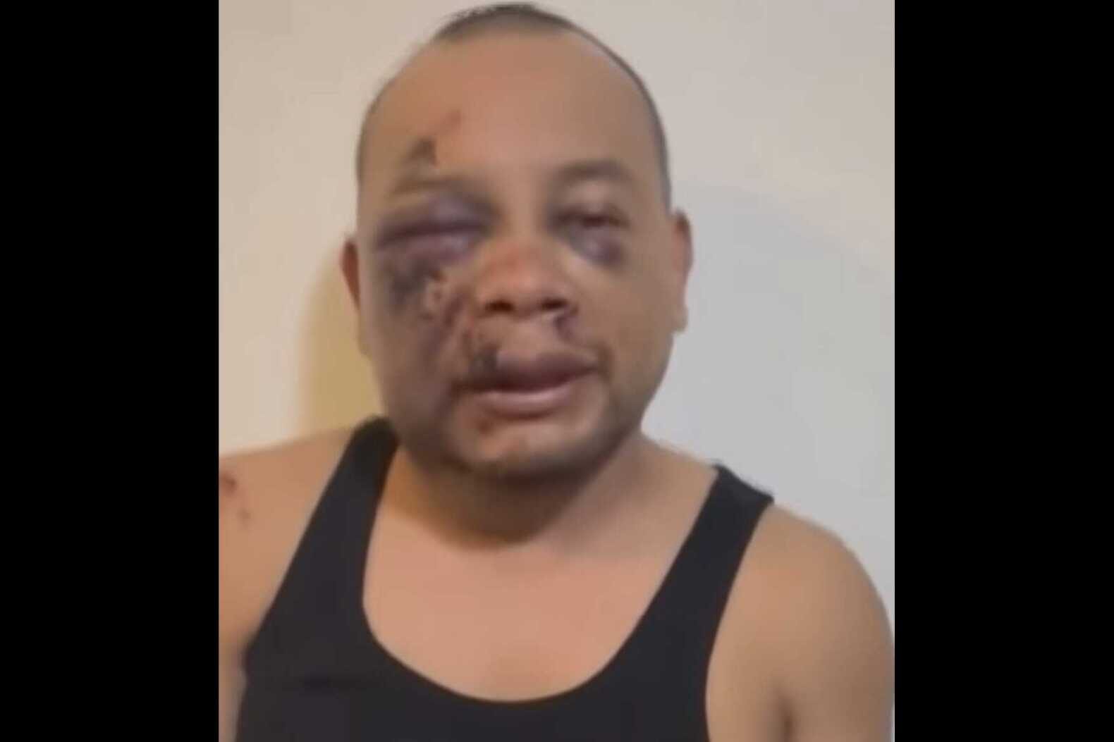 Man with a bruised left eye and cheek, wearing a black sleeveless shirt, speaking to the camera.